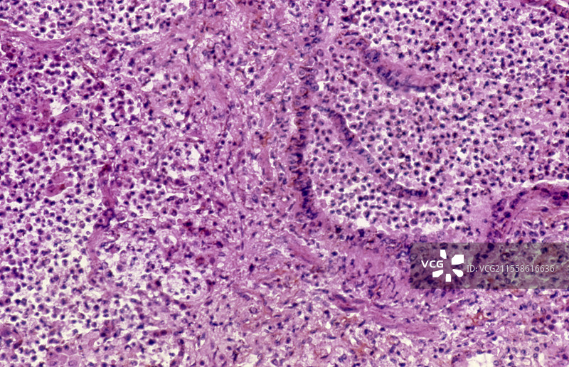 肺病，光学显微镜图像图片素材