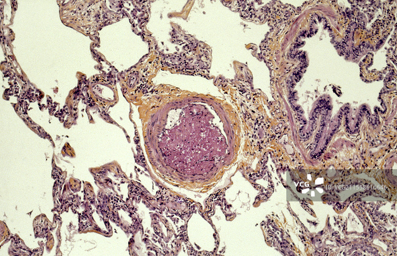 肺栓塞，光学显微镜图像图片素材
