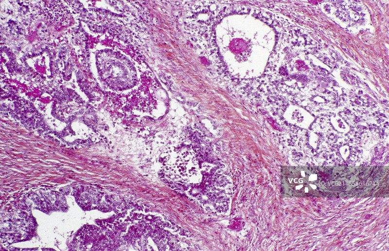 胚胎癌的光学显微镜图像图片素材