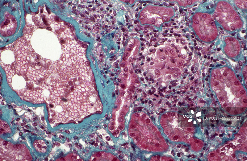 肾脏肉芽肿病，光学显微镜图像图片素材