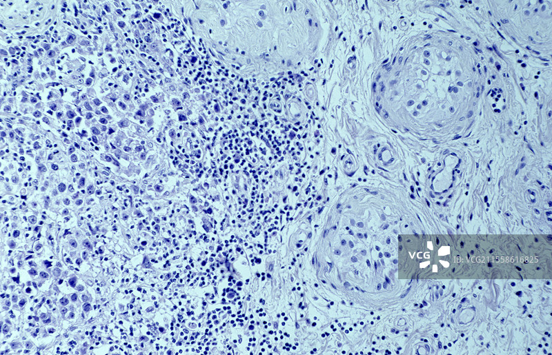 的精原细胞瘤，光学显微镜图像图片素材