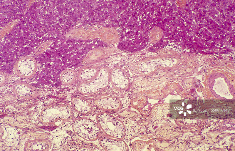 莱迪希细胞肿瘤的光学显微镜图像图片素材
