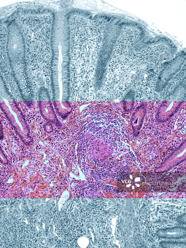结肠克罗恩病，光学显微镜图像图片素材