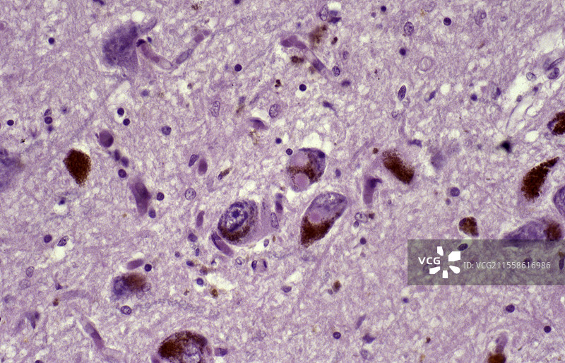 路易体痴呆，光学显微镜图像图片素材