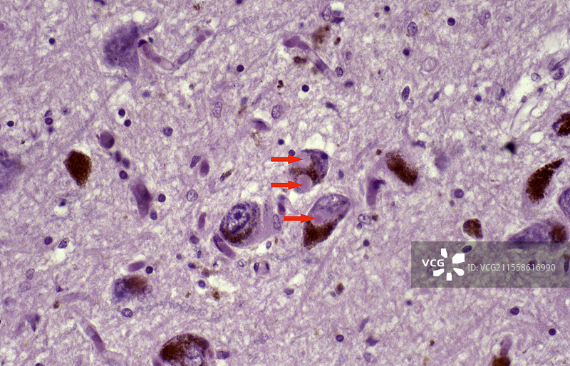 路易体痴呆，光学显微镜图像图片素材