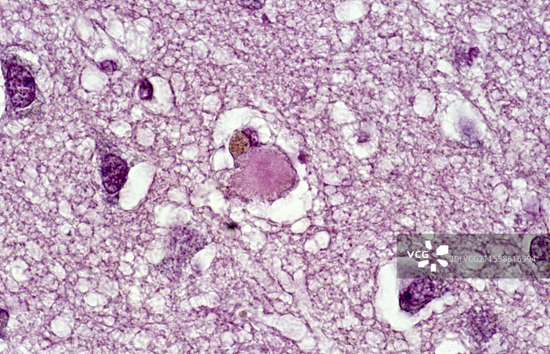 阿尔茨海默病，光学显微镜图像图片素材