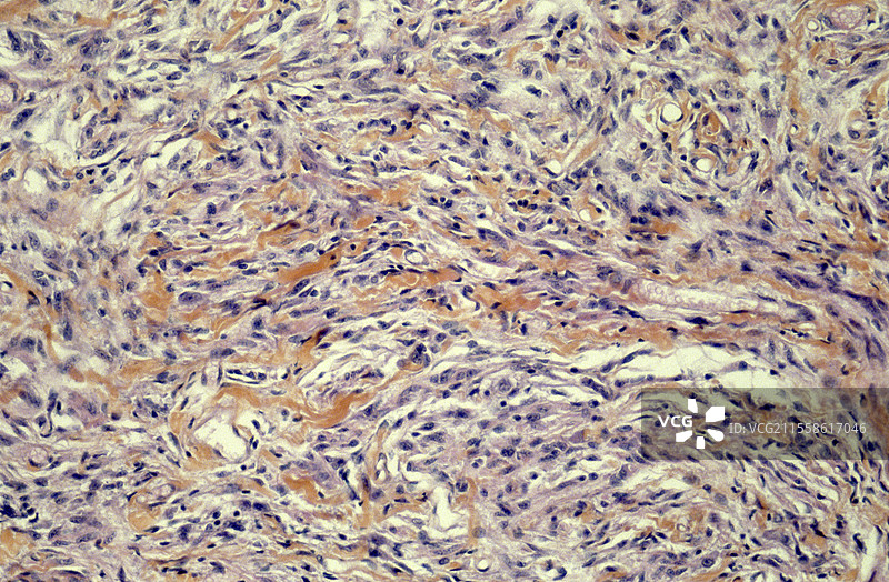 视神经胶质瘤，光学显微镜图像图片素材