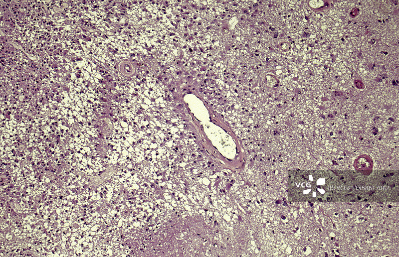 胶质母细胞瘤，光学显微镜图像图片素材