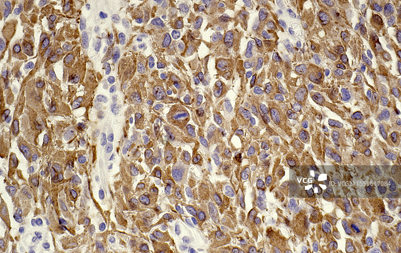 胶质母细胞瘤，光学显微镜图像图片素材