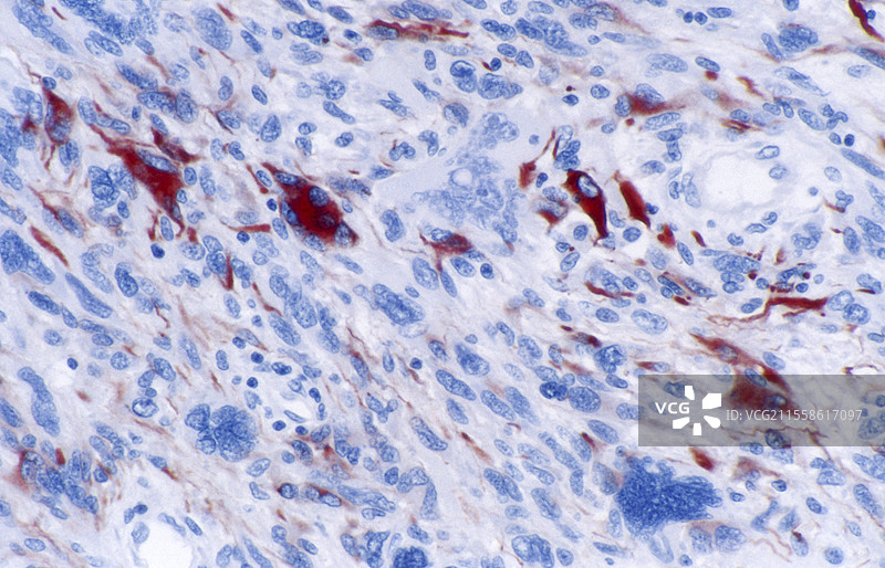 胶质母细胞瘤，光学显微镜图像图片素材