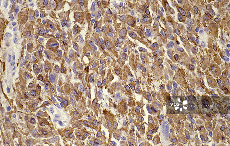 胶质母细胞瘤，光学显微镜图像图片素材