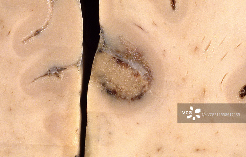 脑淋巴瘤，标本观察图片素材