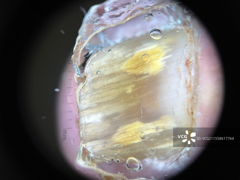 真菌指甲感染，皮肤镜检查图片素材