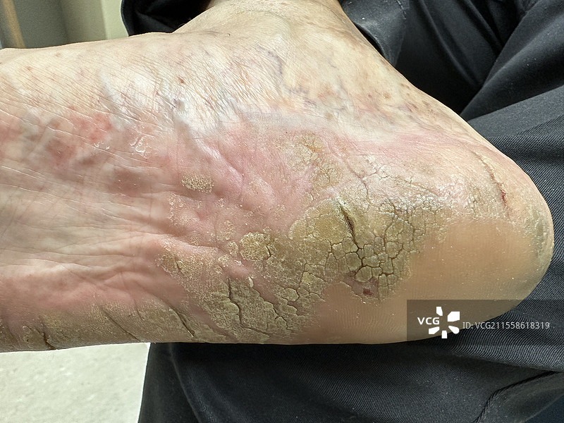足底角化病图片素材