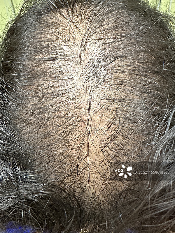 女性型脱发图片素材