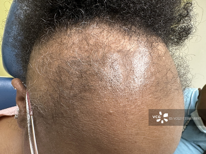 前额纤维性脱发图片素材