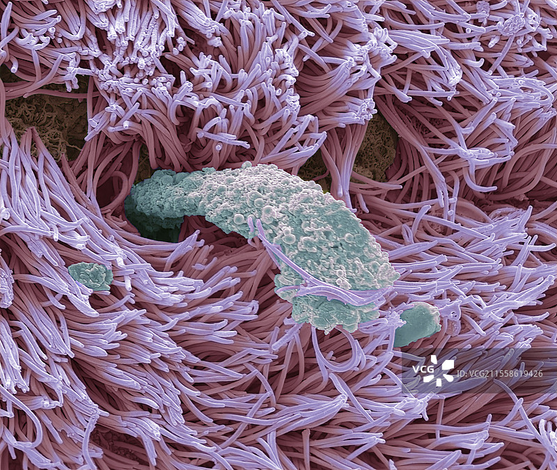 慢性鼻窦炎伴有息肉，扫描电子显微镜图像图片素材