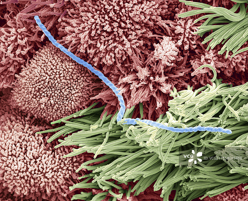 慢性鼻窦炎（CRS），扫描电子显微镜（SEM）图片素材