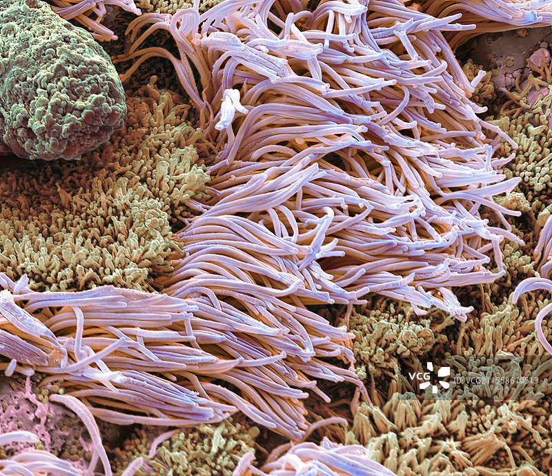 慢性鼻窦炎（CRS），扫描电子显微镜（SEM）图片素材