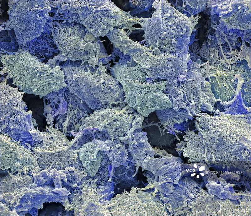 慢性鼻窦炎（CRS），扫描电子显微镜（SEM）图片素材