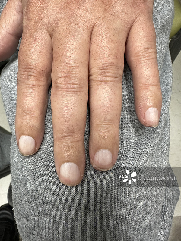 特里的指甲图片素材