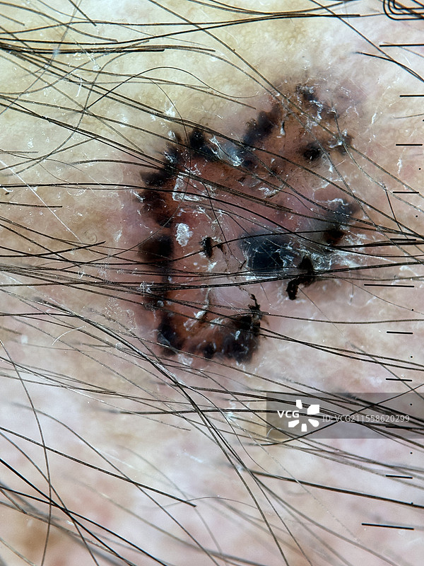 基底细胞癌，皮肤镜检查图片素材