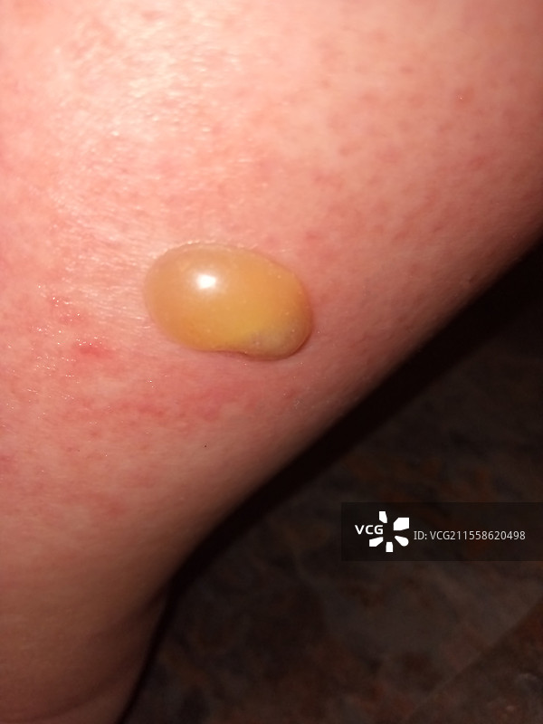 马蝇叮咬水泡图片素材