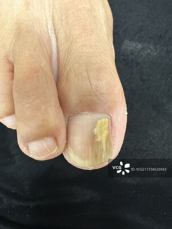 真菌指甲感染图片素材