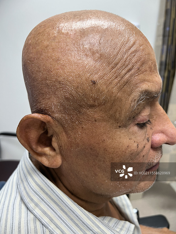 色素性基底细胞癌图片素材