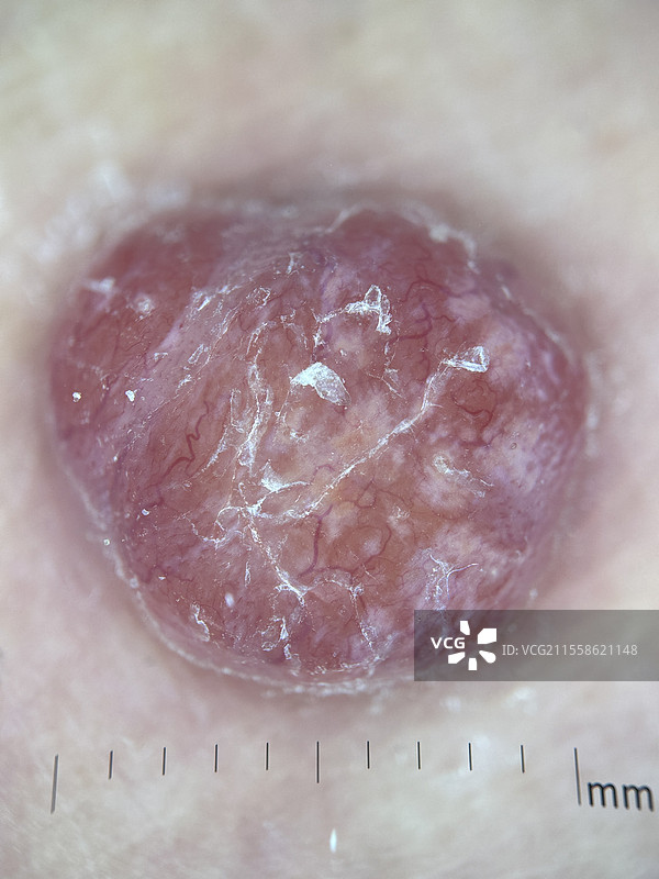 黄granuloma，皮肤镜检查图片素材
