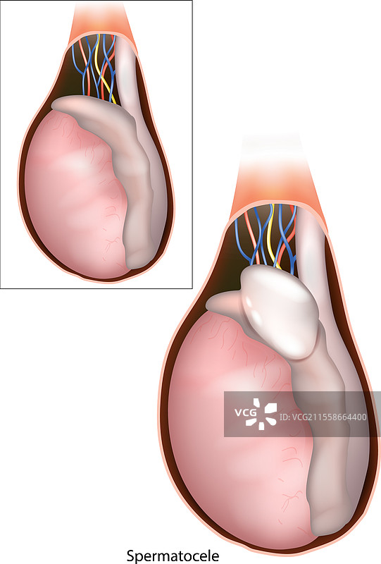 精囊囊肿 医学图片素材