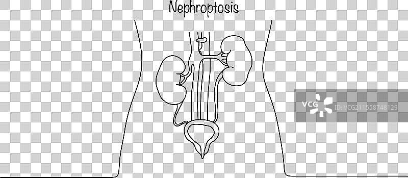 肾下垂图片素材