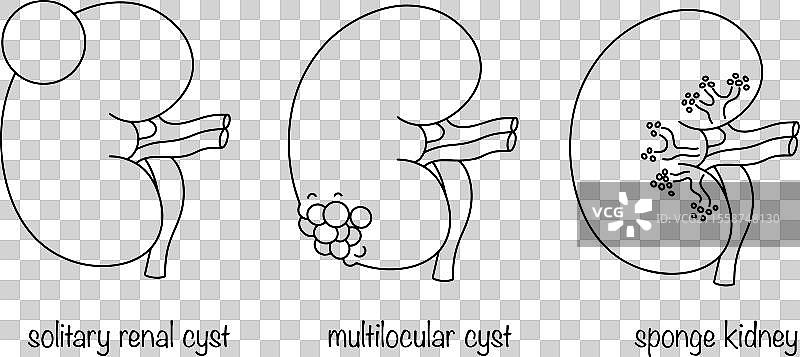 肾囊肿图片素材