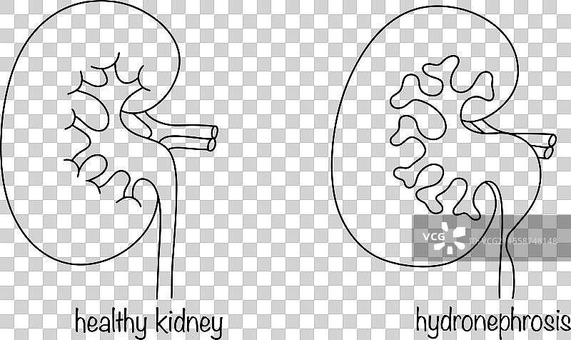 肾积水图片素材