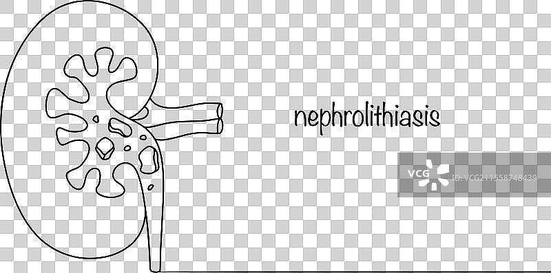 尿路结石图片素材