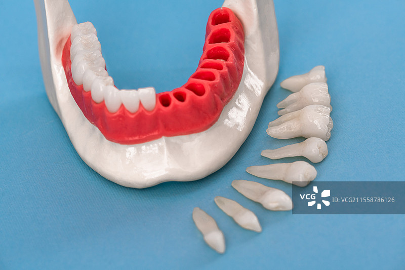 牙齿植入和牙冠安装过程的部件，孤立在蓝色背景上。医学上准确的3D模型。高质量的3D空白模型。图片素材