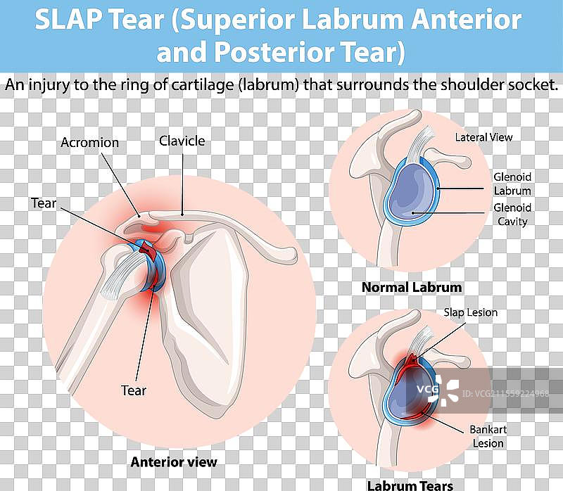 肩关节唇撕裂的详细图解图片素材