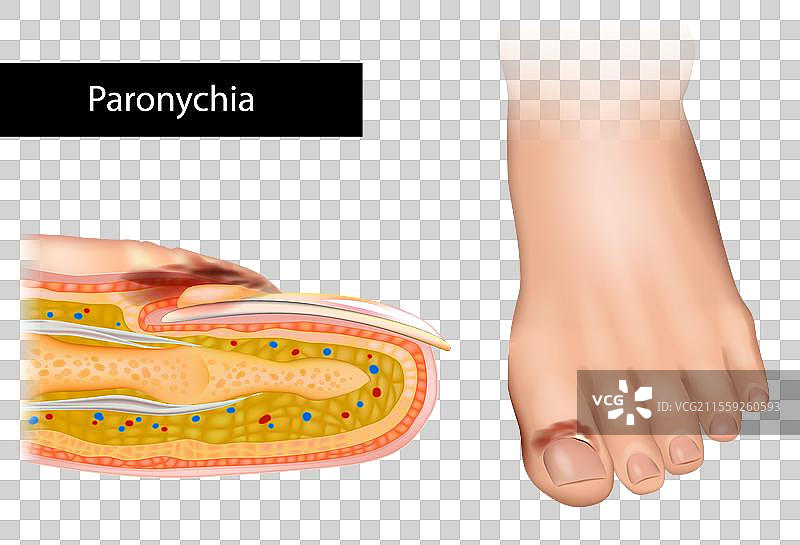 甲周炎是指围绕指甲的皮肤发炎。图片素材