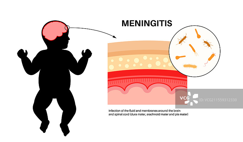 脑膜炎医学海报图片素材