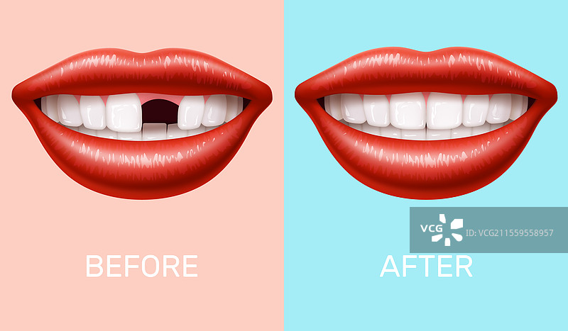 没有牙齿的女性嘴巴与牙齿植入物图片素材