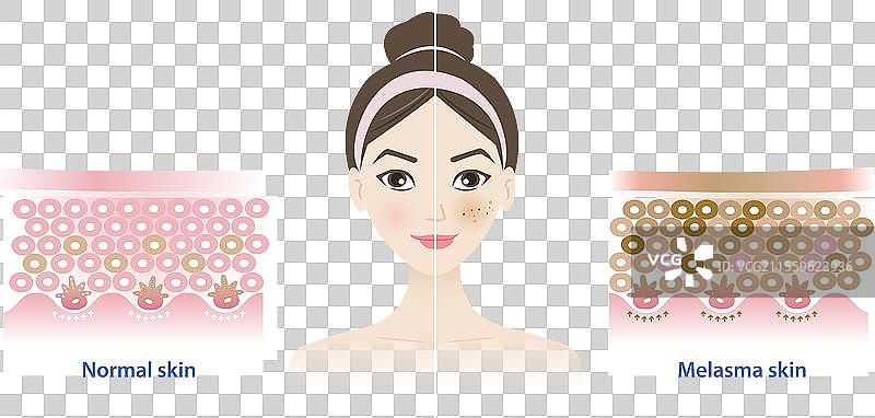 正常皮肤与黄褐斑皮肤的比较图片素材