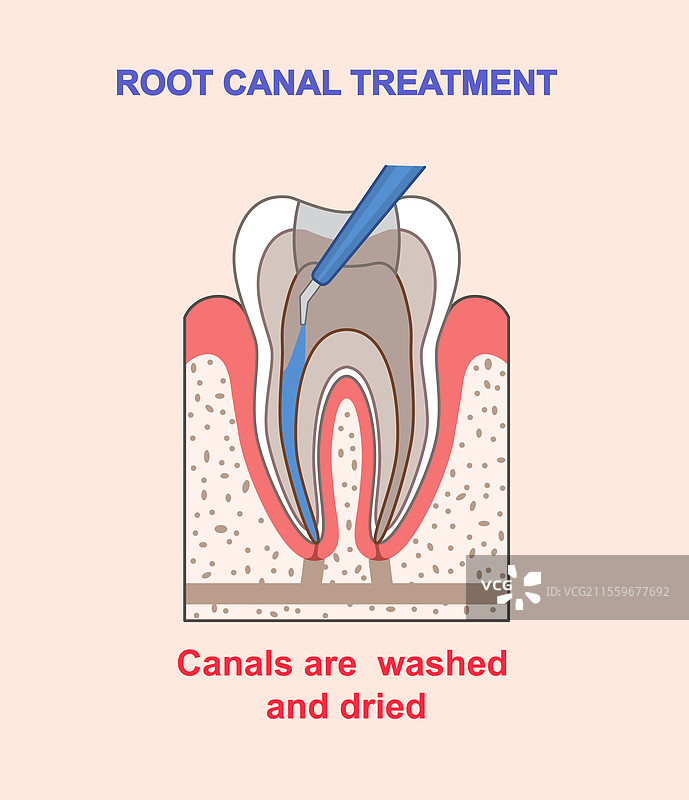 根管治疗信息图，清洗的根管图片素材
