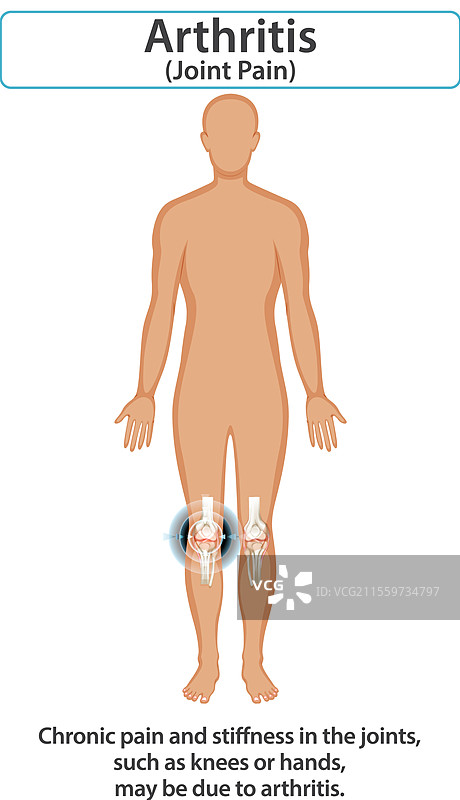 影响膝关节的关节炎图片素材