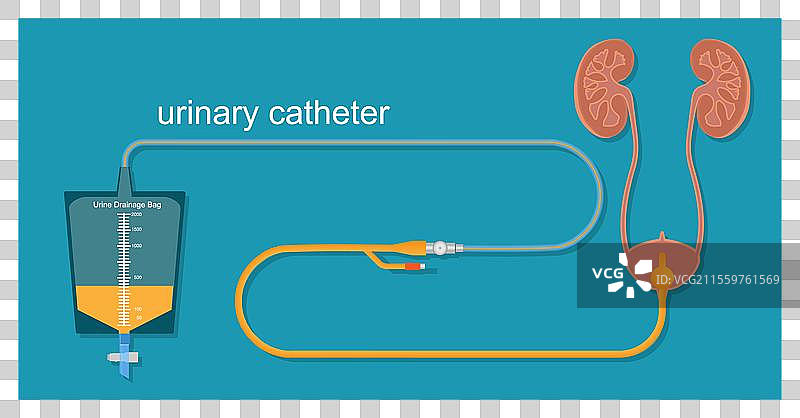 体内的尿管导管图片素材
