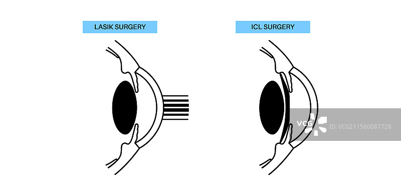 LASIK和ICL EVO图片素材