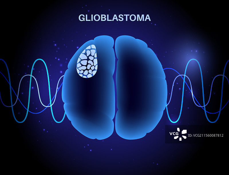 胶质母细胞瘤脑癌图片素材