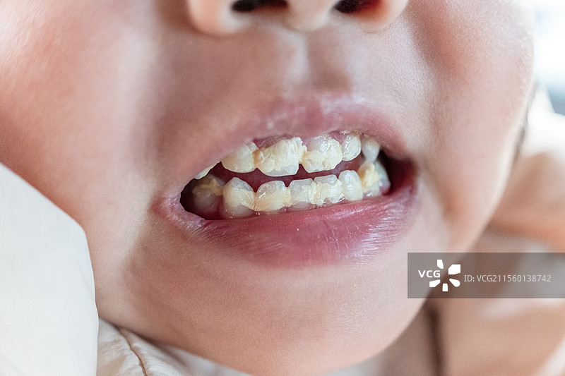 中国小女孩牙齿涂氟图片素材