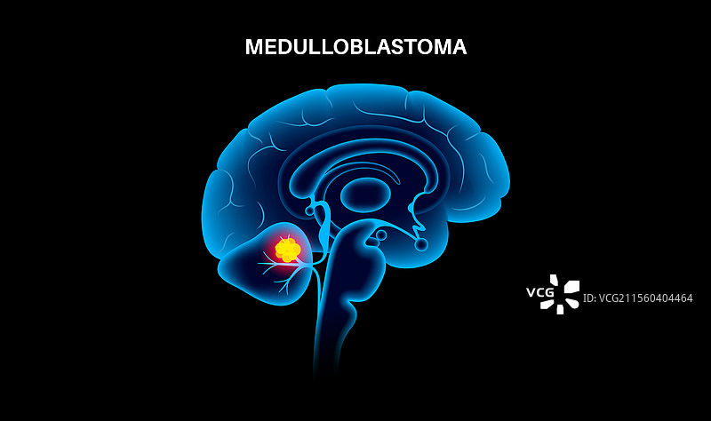 髓母细胞瘤脑癌图片素材