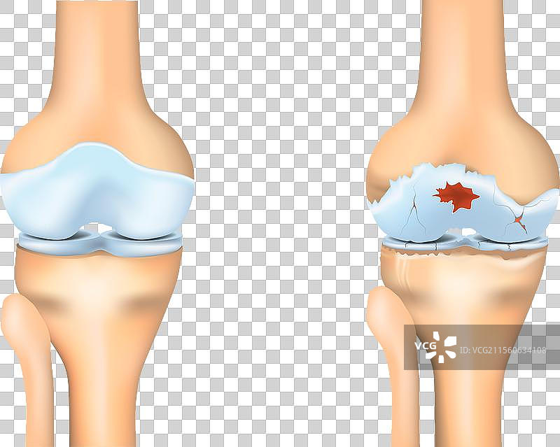膝关节骨关节炎关节退化图片素材