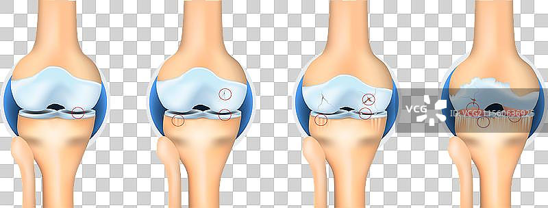 膝关节骨关节炎的各个阶段解剖结构图片素材